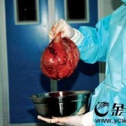 怀孕期间有囊肿（怀孕两个月右附件有个囊肿）