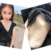 妊娠纹是什么？妊娠纹怎么消除,孕期泳装身材变化记录视频