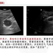 胎儿胃泡的正常值标准差是多少啊？有没有人知道呢,胎儿胃泡小是什么引起的