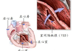 室缺是由什么原因引起的,胎儿室缺一般什么原因引起的