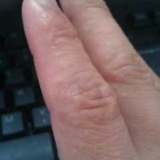 孕期手上长小水泡（孕晚期手上脚上长了许多小水泡咋回事啊）