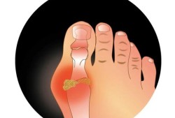 孕期脚趾痛（孕期脚趾痛什么原因）
