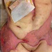 胎儿肠穿孔（胎儿肠穿孔能检查出来吗）