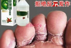 怀孕期间脚气痒怎么办（怀孕期间脚气痒怎么办用什么药）