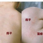 孕期长湿疹影响胎儿吗（孕妇在怀孕期间起湿疹对胎儿有影响吗）