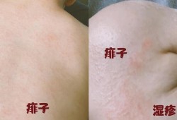 孕期长湿疹影响胎儿吗（孕妇在怀孕期间起湿疹对胎儿有影响吗）