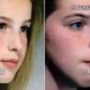 孕期鼻炎对胎儿的影响（孕期鼻炎对胎儿的影响大吗）