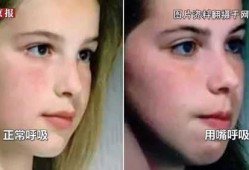孕期鼻炎对胎儿的影响（孕期鼻炎对胎儿的影响大吗）