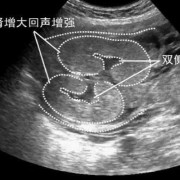 双肾盂未见分离是什么意思,胎儿双侧肾盂无分离是男是女