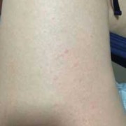 孕期腿上长疙瘩是胎毒（孕期腿上长疙瘩是胎毒图片）