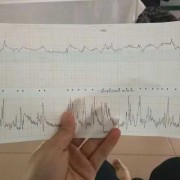 胎儿心率170正常吗（胎儿心跳达到170了怎么办）