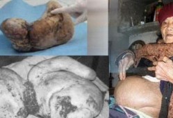胎儿死在腹中的原因有哪些,胎儿死在腹中是什么症状