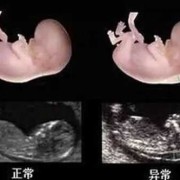 怀孕12周胎儿彩超图（孕12周了检查宝宝是单脐动脉是怎么回事）