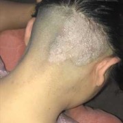 孕期得了脂溢性皮炎（怀孕初期头皮痒，头皮屑多怎么办）