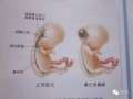 胎儿淋巴水囊瘤（胎儿颈部水囊瘤无水肿是怎么回事?能否治疗）