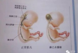 胎儿淋巴水囊瘤（胎儿颈部水囊瘤无水肿是怎么回事?能否治疗）
