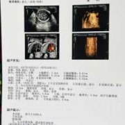 胎儿光片（胎儿光斑什么意思）