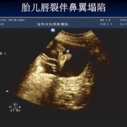 胎儿有唇裂（什么是胎梦）