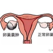 胎儿卵巢囊肿（胎儿卵巢囊肿是什么原因引起的）