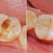 孕期蛀牙掉了（孕期蛀牙掉了一半,可以填补吗）