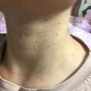 孕期脖子长痘（孕期脖子长痘痘是什么原因）