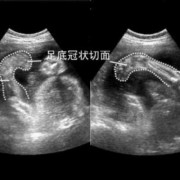 胎儿左足有点不正是什么原因,胎儿不正怎么回事