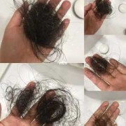 孕期脱发严重（产后脱发严重该怎么办）