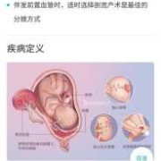 帆状胎盘的胎儿能要吗（帆状胎盘对胎儿有影响吗）