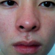 孕期鼻子红（孕期鼻子红是什么原因）