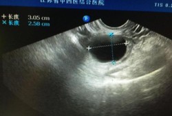 卵巢囊肿影响胎儿发育（卵巢囊肿影响胎儿发育吗）