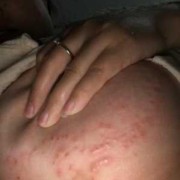 孕期胸前痒（孕期胸前痒）