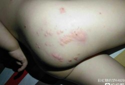 孕期屁股长痘痘是怎么回事（孕期屁股长痘痘是怎么回事图片）