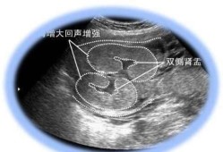 胎儿双肾盂无分离（胎儿双肾盂无分离是男孩还是女孩）