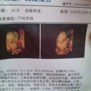 怀孕23周胎儿彩超图（怀孕23周胎儿彩超图片）