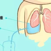 胎儿胸腔积液怎么办（胎儿胸腔积液怎么办,能要吗）