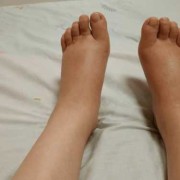 孕期脚裸肿（孕期水肿是怎么回事）