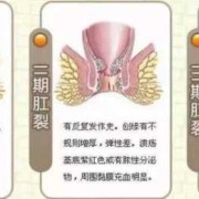 孕期肛门出血怎么回事（孕期肛门出血怎么回事儿）