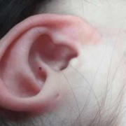 宝宝耳朵外道碰出血了了怎么办？宝宝出现这个情况会影响耳膜吗,撞到胎儿会有胎记吗