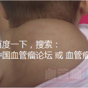 胎儿颈部淋巴管瘤（胎儿颈部淋巴管瘤严重吗）