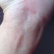 孕晚期脚上手上长了很多水泡如何处理,孕期手上起小水泡图片大全