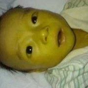 胆道闭锁几个月会发现,胎儿胆道闭锁能存活吗能活多久