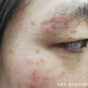 孕期脸上长疣（孕期脸上长疣怎么办）