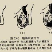 胎儿鞘膜积液（胎儿鞘膜积液是什么原因造成的）