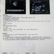 nt图片胎儿（NT结果怎么看）