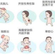 胎儿致死性畸形（胎儿致死性畸形）