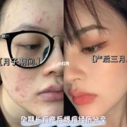 孕期长痘严重（孕期长痘严重怎么办）