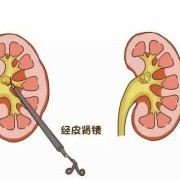 孕期尿路结石（孕期尿路结石怎么办）