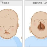 胎儿下嘴唇裂（胎儿下嘴唇裂开怎么办）