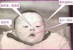 唐氏胎儿有什么表现,唐氏胎儿在母体的征兆