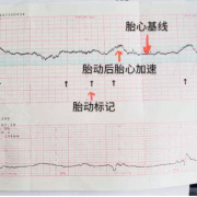 胎心148次正常吗,胎儿心率148次/分是男还是女